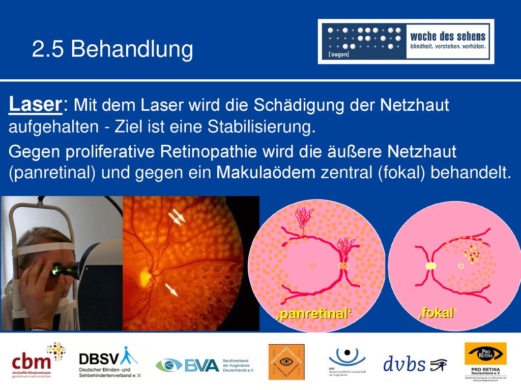 2.5 Behandlung Laser: Mit dem Laser wird die Schädigung der Netzhaut aufgehalten - Ziel ist eine Stabilisierung.