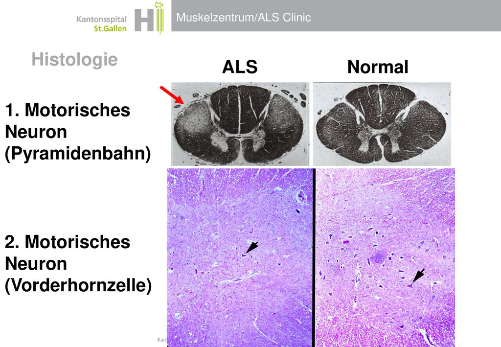 Histologie ALS Normal 1. Motorisches Neuron (Pyramidenbahn) 2. Motorisches Neuron (Vorderhornzelle)