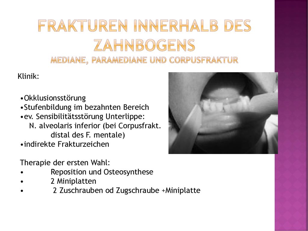 Frakturen innerhalb des Zahnbogens mediane, paramediane und Corpusfraktur