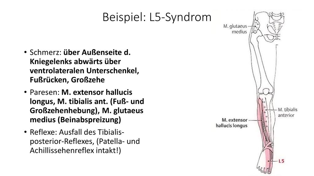 Beispiel: L5-Syndrom Schmerz: über Außenseite d. Kniegelenks abwärts über ventrolateralen Unterschenkel, Fußrücken, Großzehe.