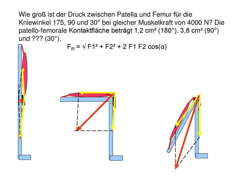 Wie groß ist der Druck zwischen Patella und Femur für die Kniewinkel 175, 90 und 30° bei gleicher Muskelkraft von 4000 N Die patello-femorale Kontaktfläche beträgt 1,2 cm² (180°), 3,8 cm² (90°) und (30°).