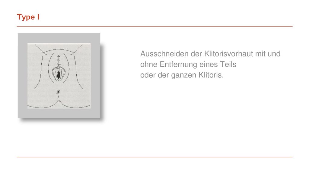 Type I Ausschneiden der Klitorisvorhaut mit und ohne Entfernung eines Teils.