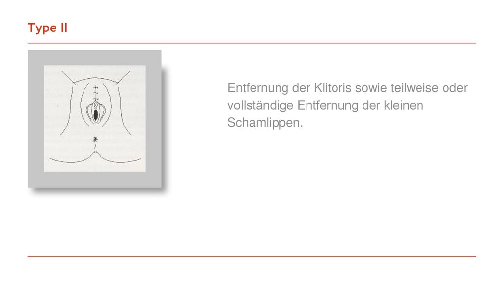 Type II Entfernung der Klitoris sowie teilweise oder vollständige Entfernung der kleinen Schamlippen.