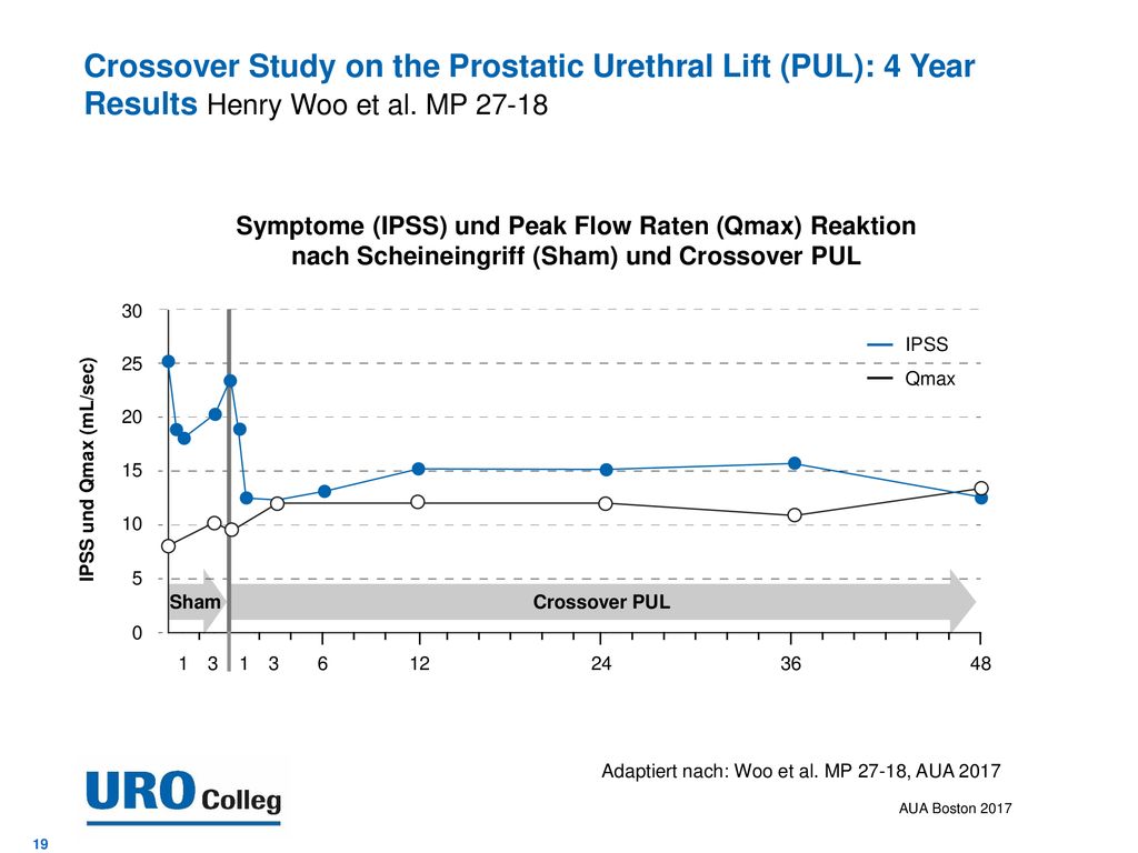 Crossover Study on the Prostatic Urethral Lift (PUL): 4 Year Results Henry Woo et al. MP 27-18