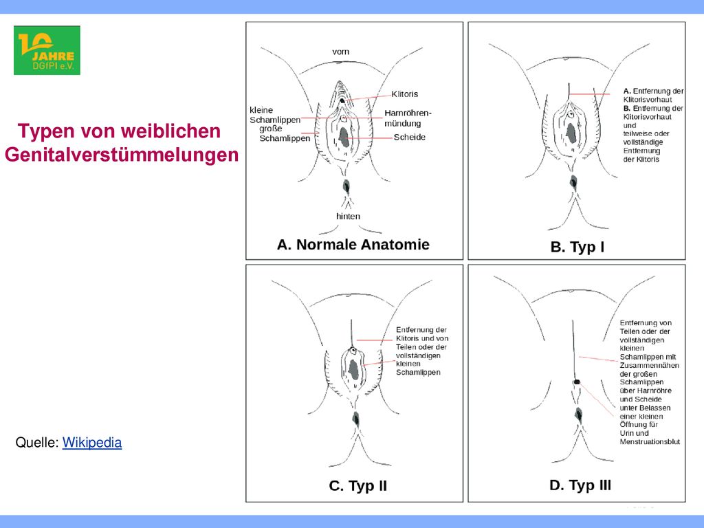 Typen von weiblichen Genitalverstümmelungen
