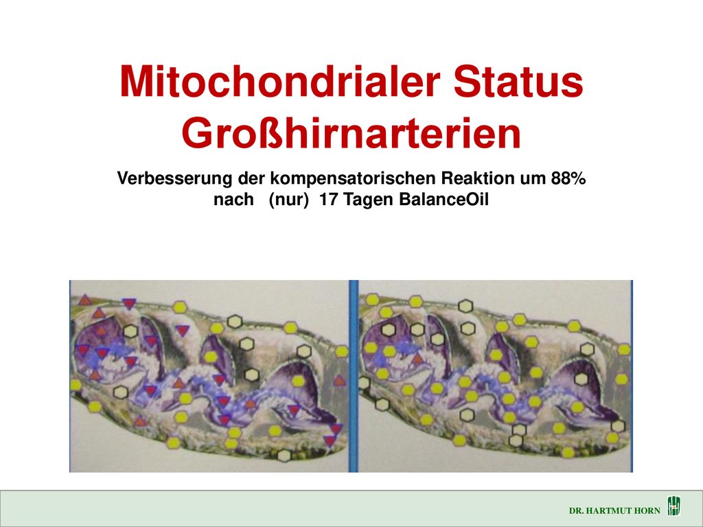 Mitochondrialer Status Großhirnarterien Verbesserung der kompensatorischen Reaktion um 88% nach (nur) 17 Tagen BalanceOil