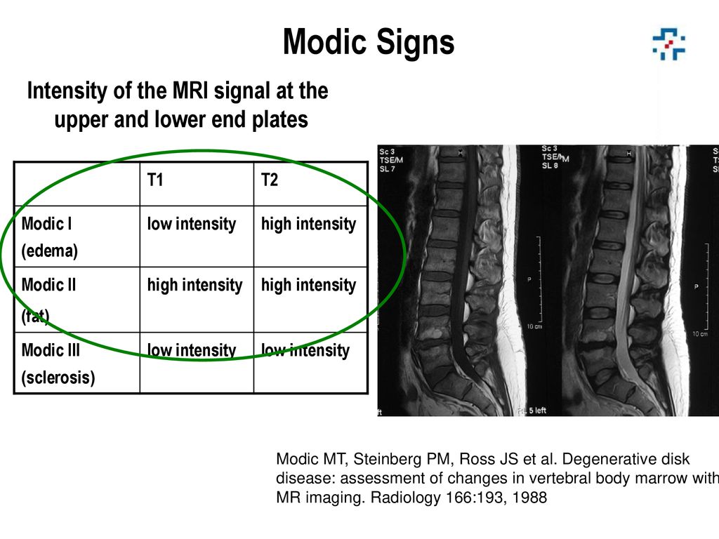 Modic Signs Intensity of the MRI signal at the upper and lower end plates. T1. T2. Modic I (edema)