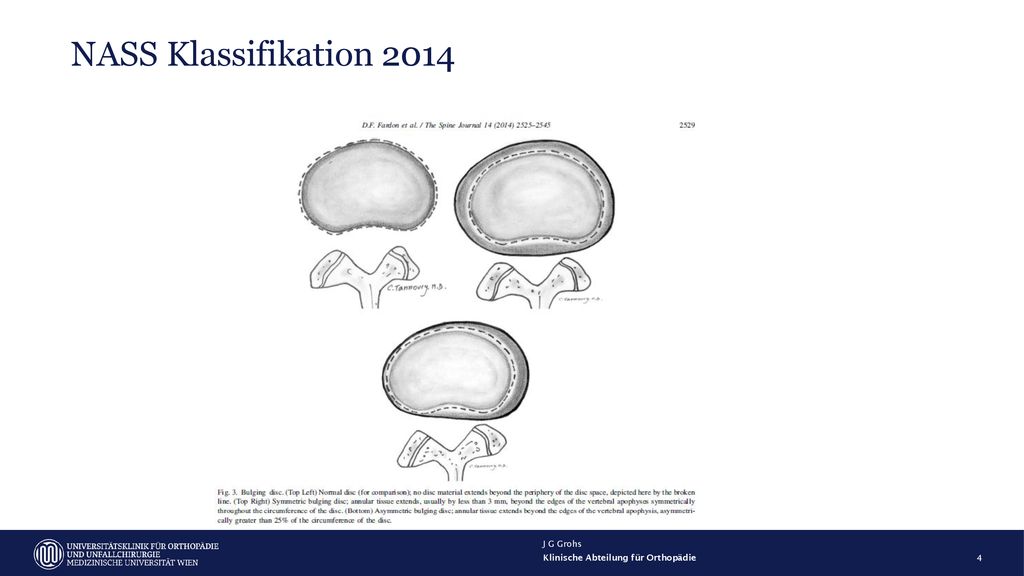 NASS Klassifikation 2014 J G Grohs Klinische Abteilung für Orthopädie