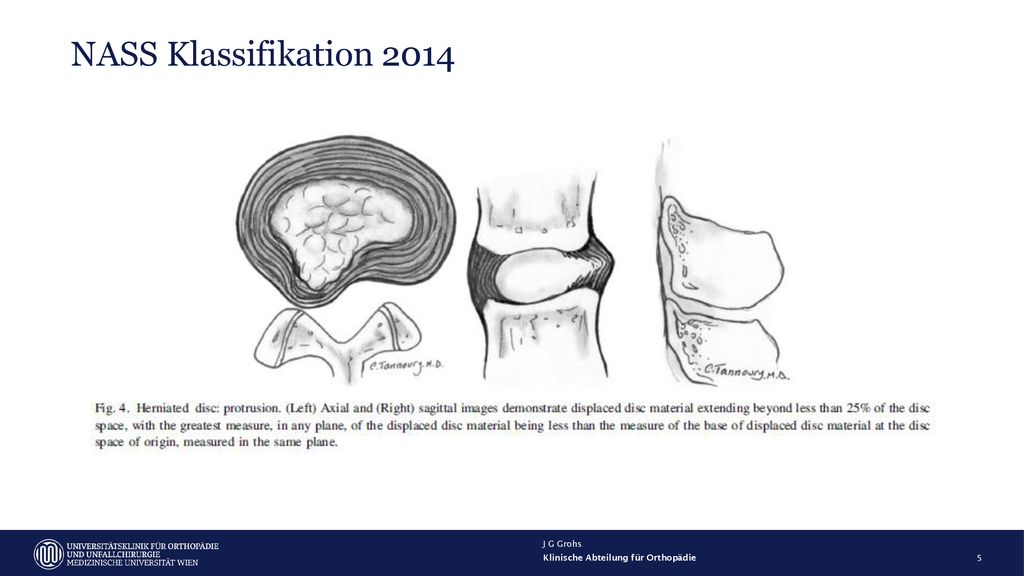 NASS Klassifikation 2014 J G Grohs Klinische Abteilung für Orthopädie
