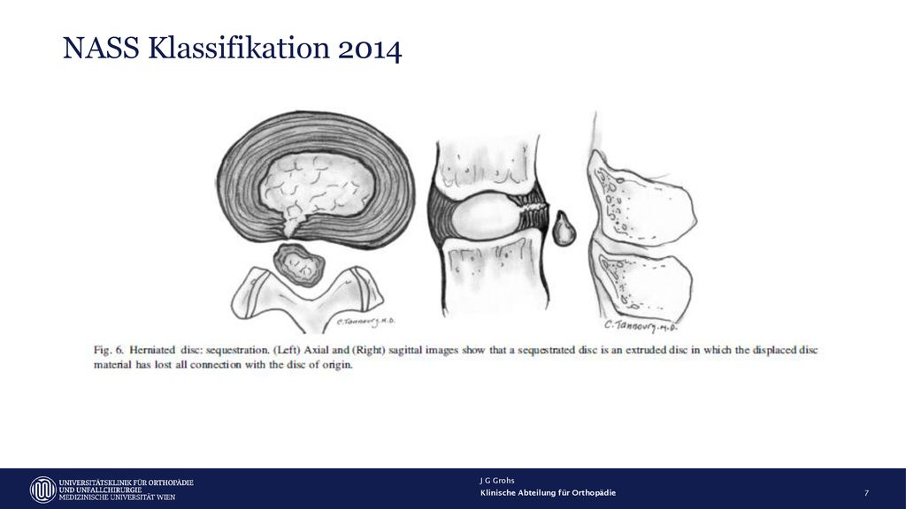 NASS Klassifikation 2014 J G Grohs Klinische Abteilung für Orthopädie