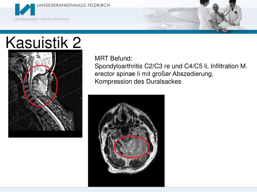 Kasuistik 2 MRT Befund: Spondyloarthritis C2/C3 re und C4/C5 li, Infiltration M. erector spinae li mit großer Abszedierung,