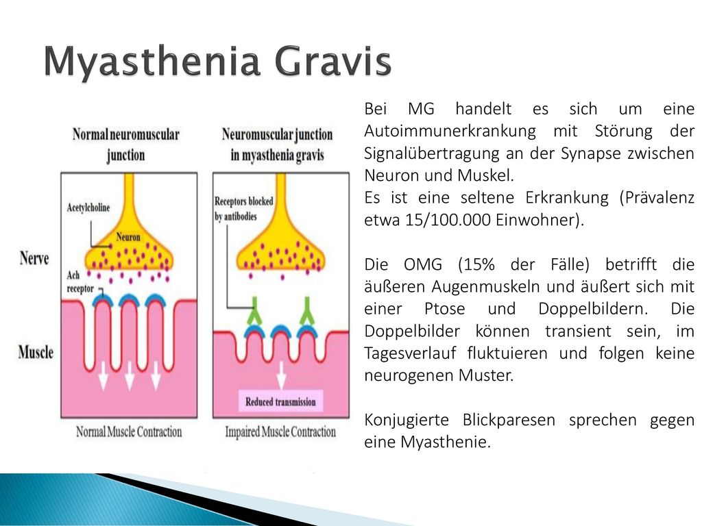 Myasthenia Gravis Bei MG handelt es sich um eine Autoimmunerkrankung mit Störung der Signalübertragung an der Synapse zwischen Neuron und Muskel.