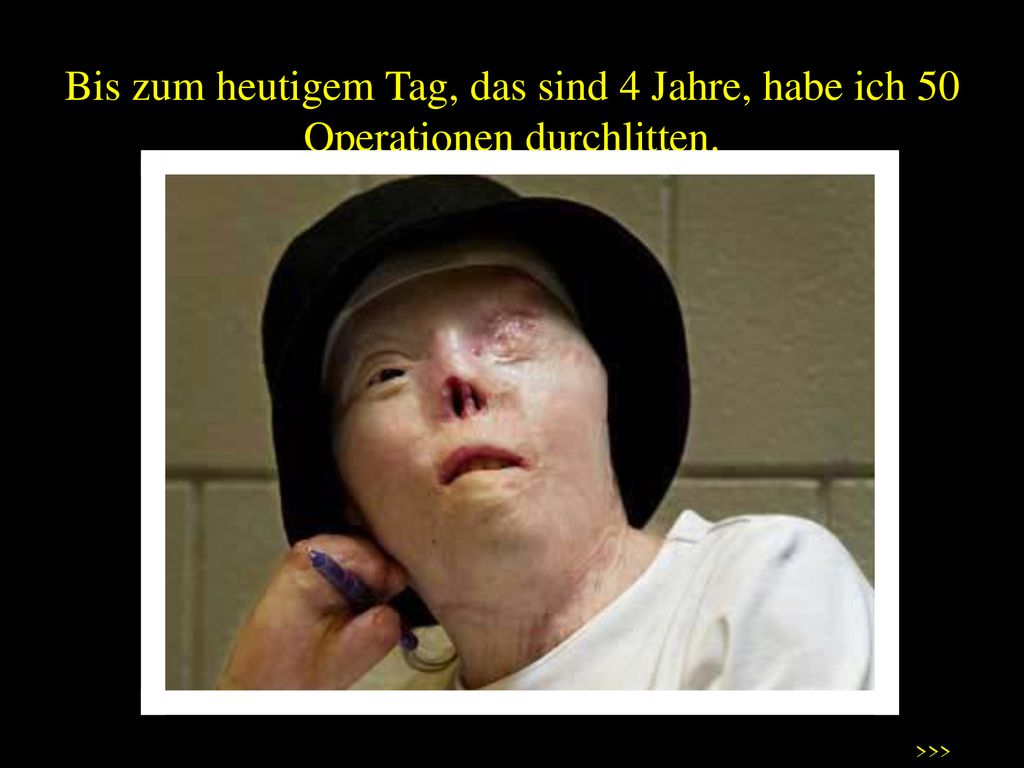Bis zum heutigem Tag, das sind 4 Jahre, habe ich 50 Operationen durchlitten.