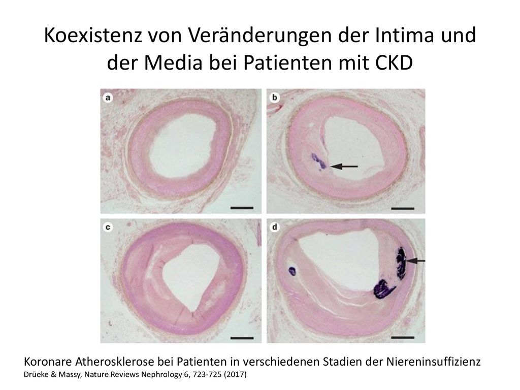 Koexistenz von Veränderungen der Intima und der Media bei Patienten mit CKD