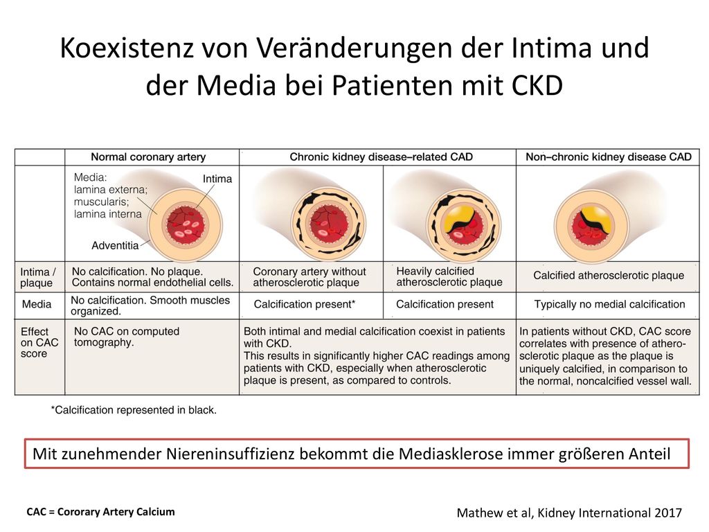 Koexistenz von Veränderungen der Intima und der Media bei Patienten mit CKD