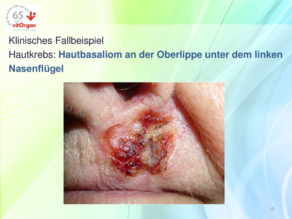 Klinisches Fallbeispiel Hautkrebs: Hautbasaliom an der Oberlippe unter dem linken Nasenflügel
