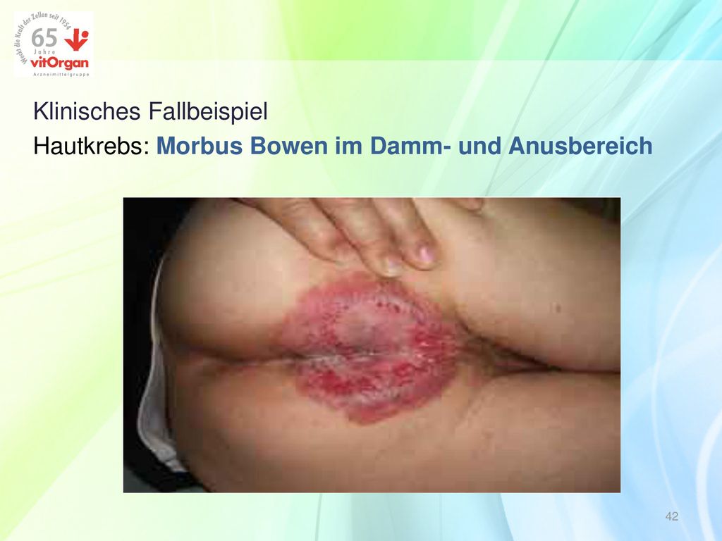 Klinisches Fallbeispiel Hautkrebs: Morbus Bowen im Damm- und Anusbereich