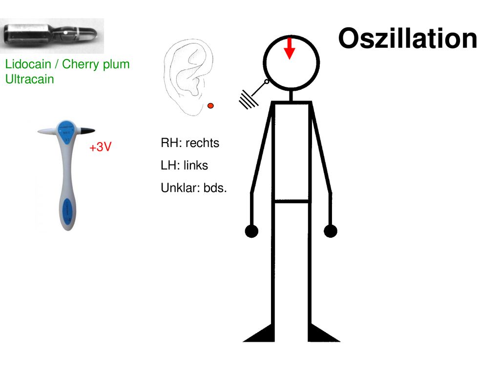 Oszillation Lidocain / Cherry plum Ultracain RH: rechts +3V LH: links