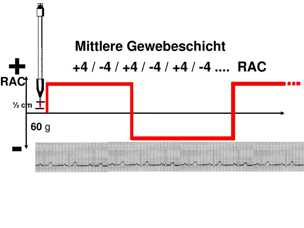 + - Mittlere Gewebeschicht +4 / -4 / +4 / -4 / +4 / RAC RAC