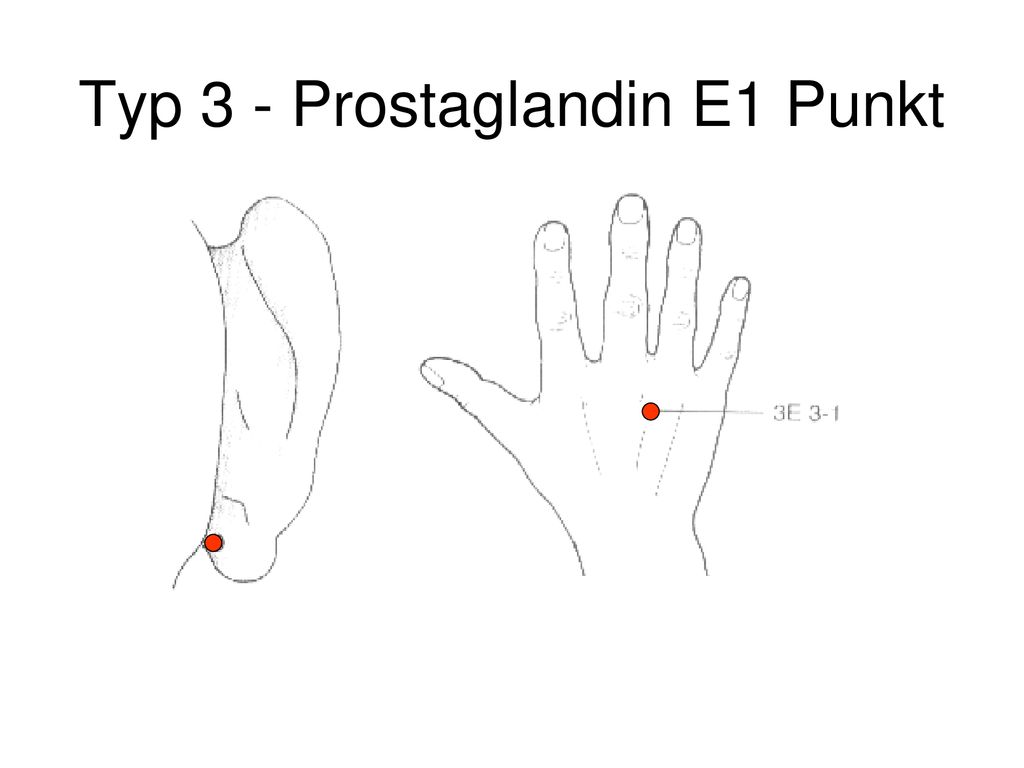 Typ 3 - Prostaglandin E1 Punkt