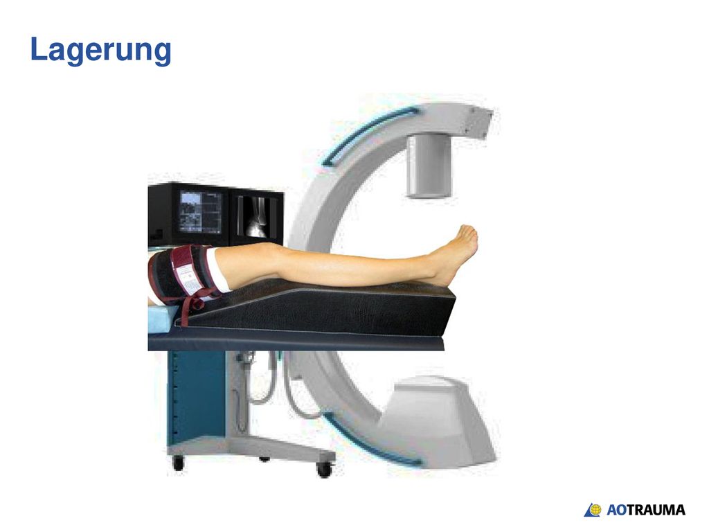 Lagerung Anlegen einer Blutsperre-Manschette am Oberschenkel der betreffenden Seite, Aufblasen nur wenn nötig.