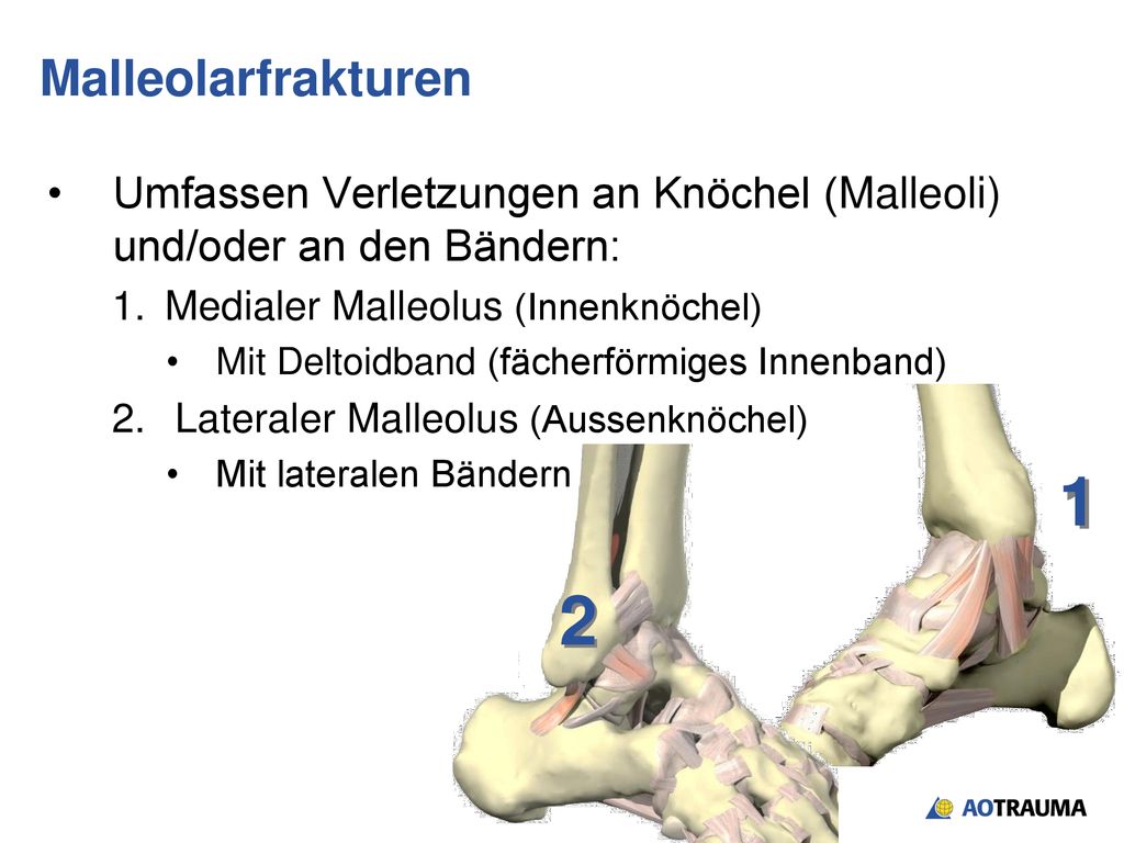 Malleolarfrakturen Umfassen Verletzungen an Knöchel (Malleoli) und/oder an den Bändern: Medialer Malleolus (Innenknöchel)