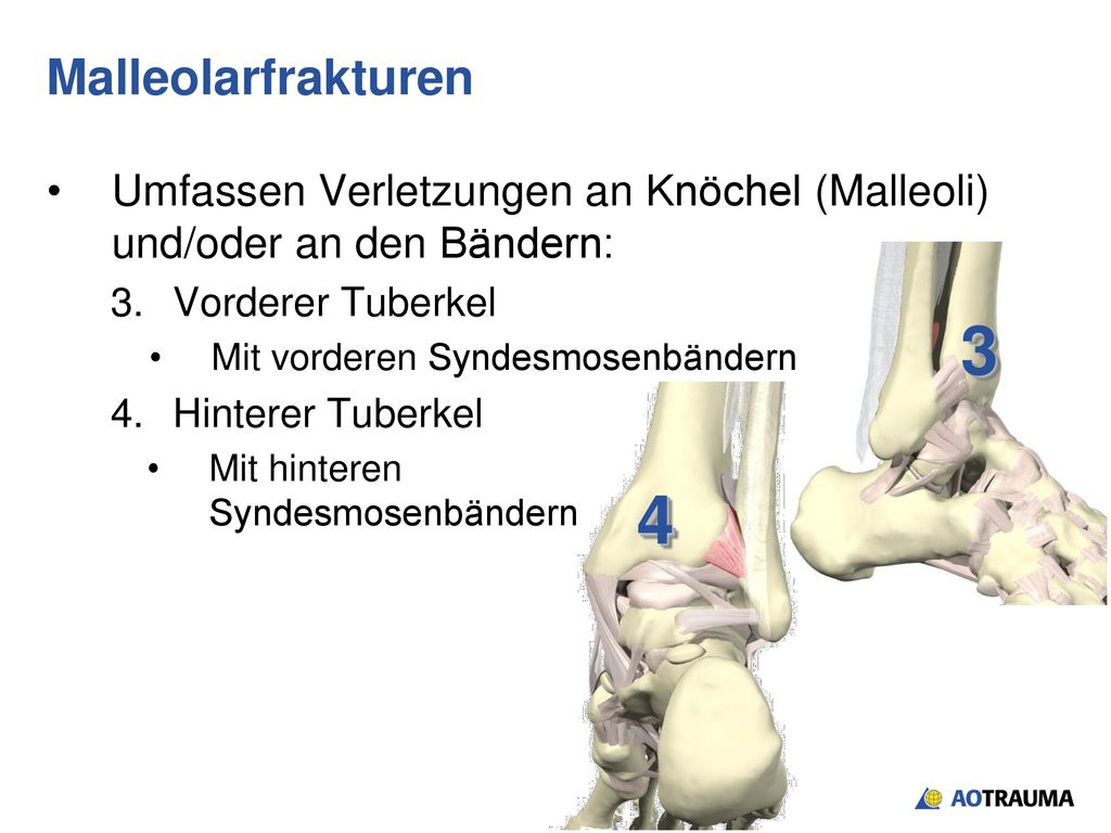 Malleolarfrakturen Umfassen Verletzungen an Knöchel (Malleoli) und/oder an den Bändern: Vorderer Tuberkel.