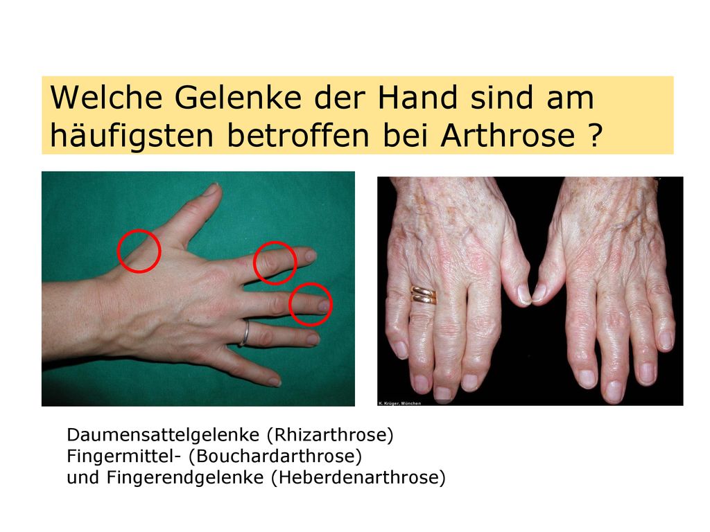 Welche Gelenke der Hand sind am häufigsten betroffen bei Arthrose