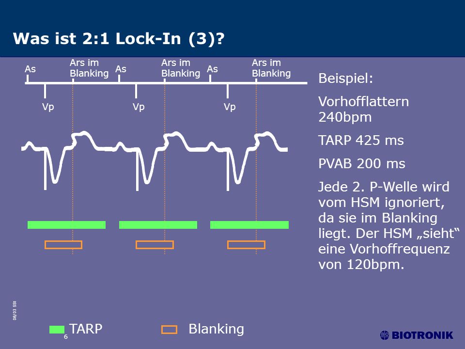 Was ist 2:1 Lock-In (3) Beispiel: Vorhofflattern 240bpm TARP 425 ms