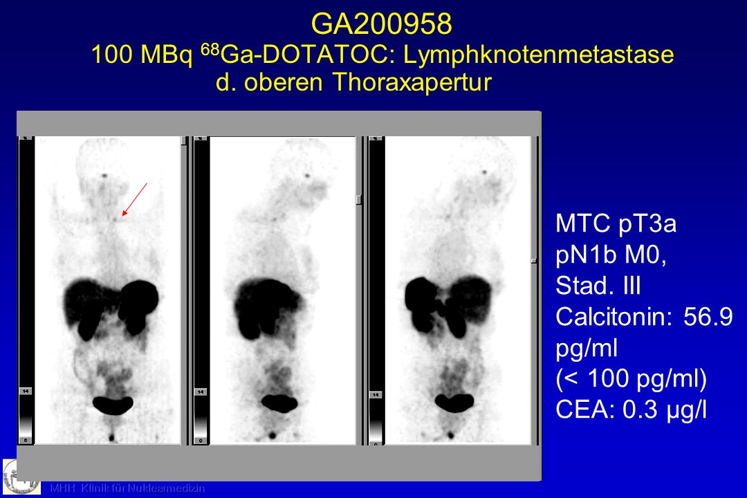 GA MBq 68Ga-DOTATOC: Lymphknotenmetastase