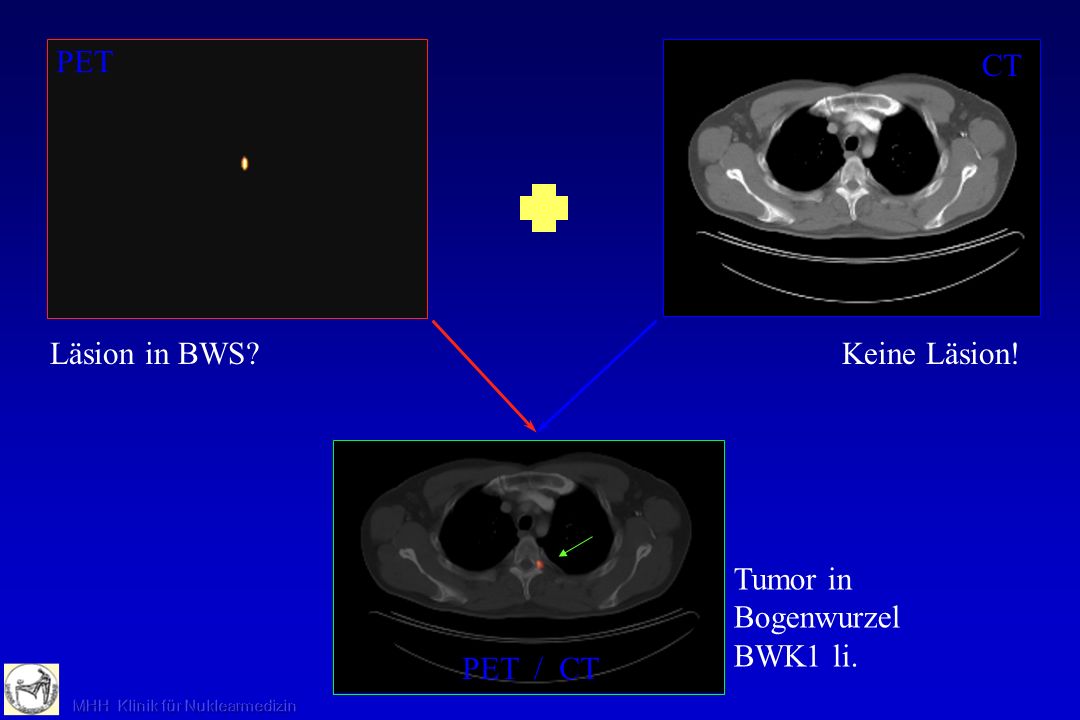 PET CT Läsion in BWS Keine Läsion! PET / CT Tumor in Bogenwurzel BWK1 li.