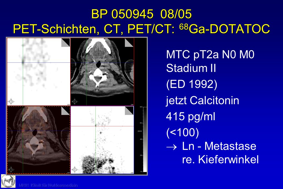 BP /05 PET-Schichten, CT, PET/CT: 68Ga-DOTATOC