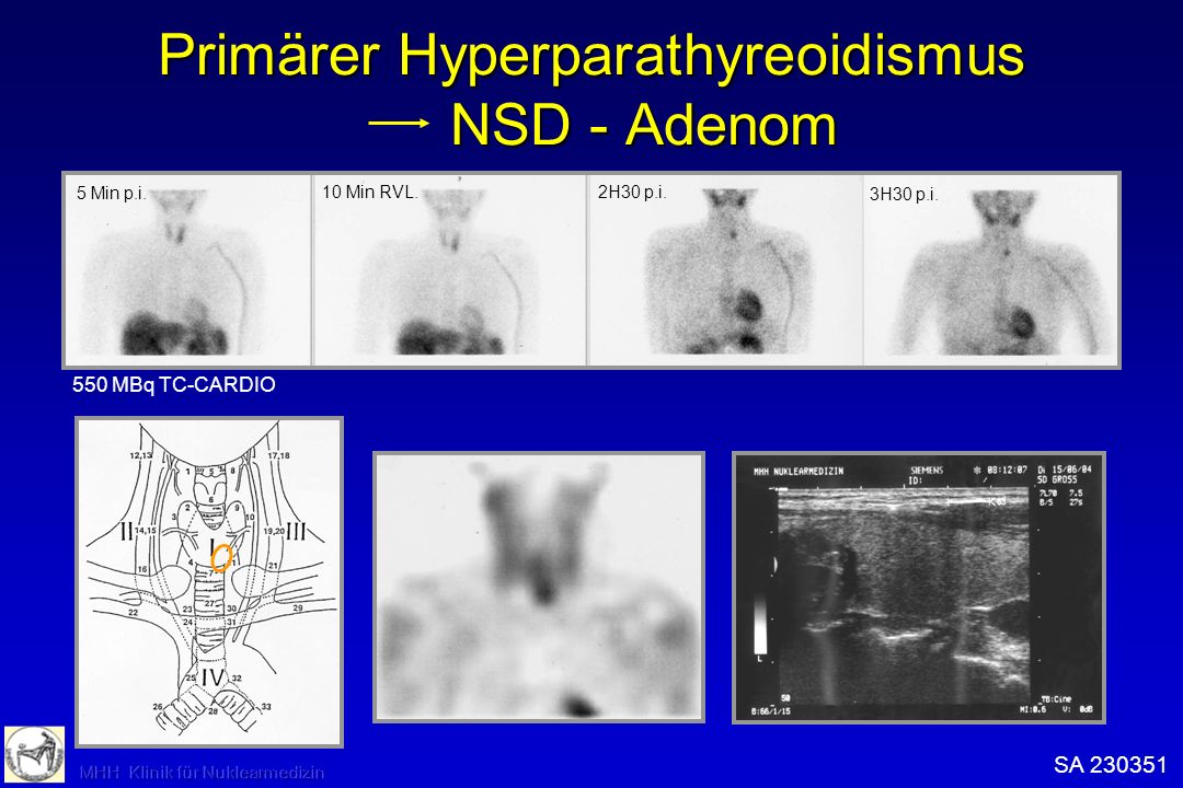 Primärer Hyperparathyreoidismus NSD - Adenom