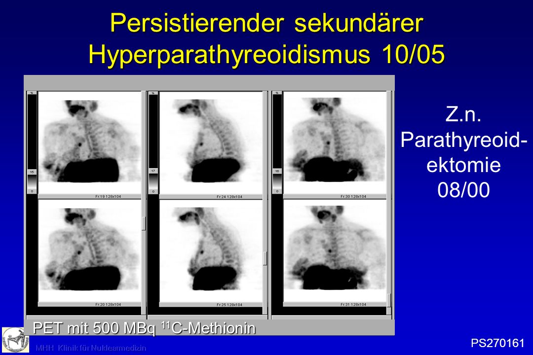 Persistierender sekundärer Hyperparathyreoidismus 10/05
