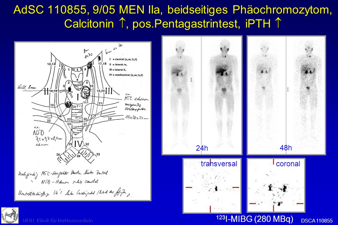 AdSC , 9/05 MEN IIa, beidseitiges Phäochromozytom, Calcitonin , pos.Pentagastrintest, iPTH 