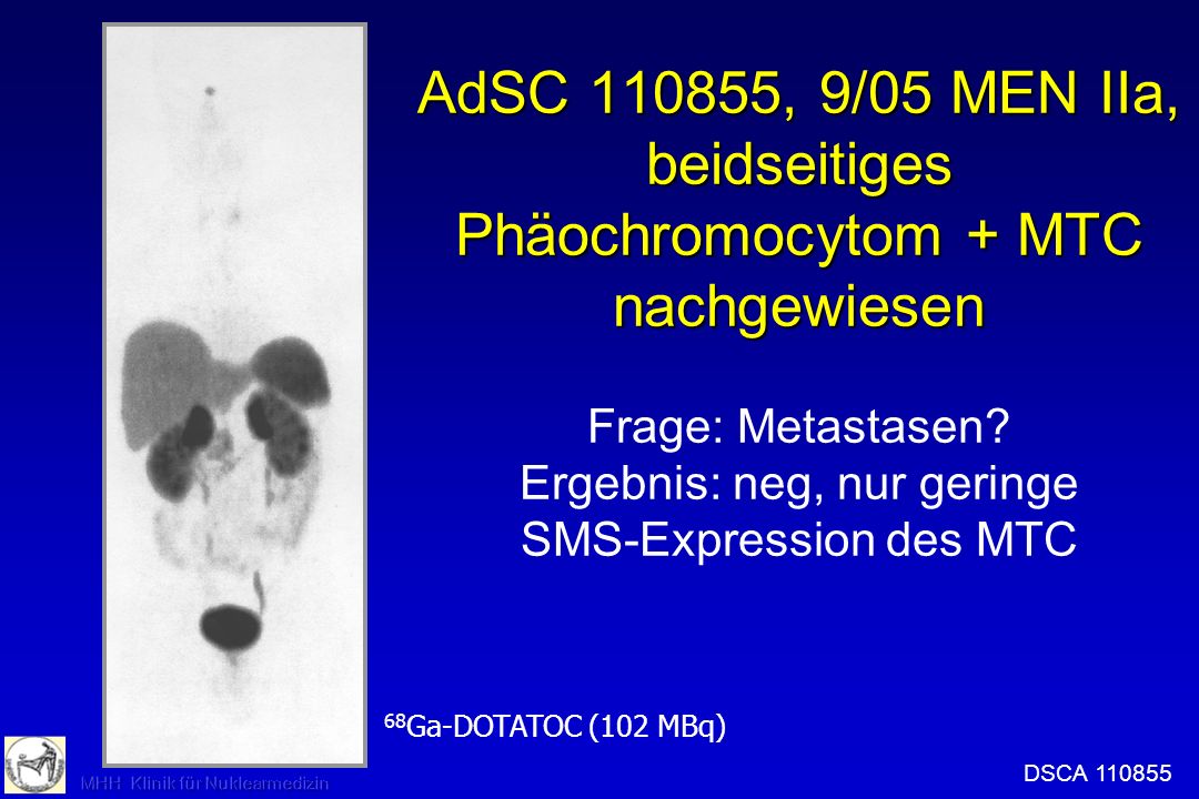 AdSC , 9/05 MEN IIa, beidseitiges Phäochromocytom + MTC nachgewiesen Frage: Metastasen Ergebnis: neg, nur geringe SMS-Expression des MTC