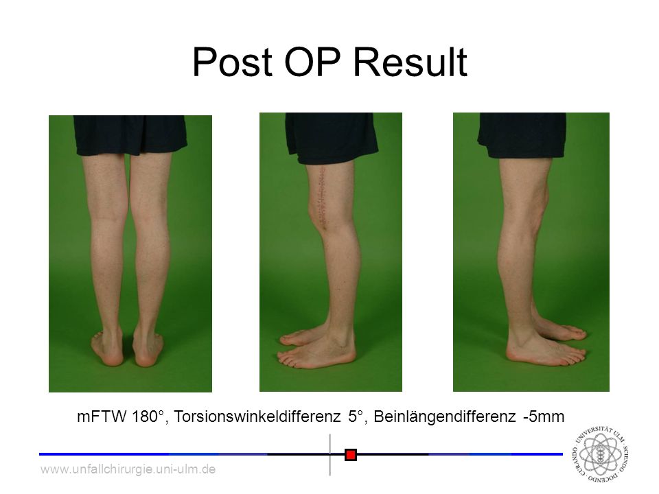 Post OP Result mFTW 180°, Torsionswinkeldifferenz 5°, Beinlängendifferenz -5mm