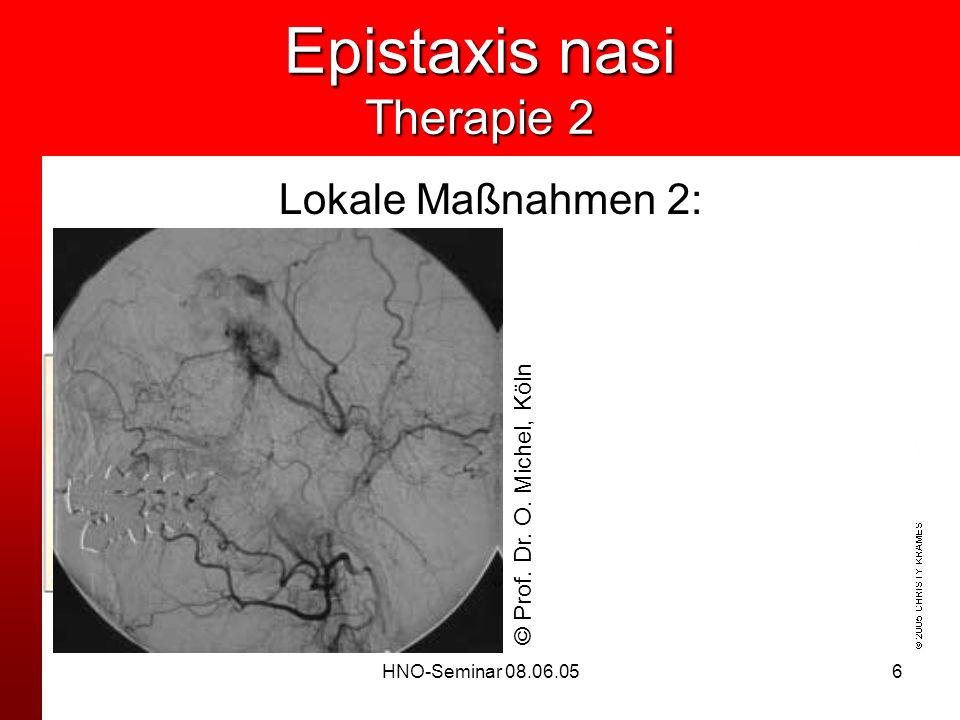 Epistaxis nasi Therapie 2