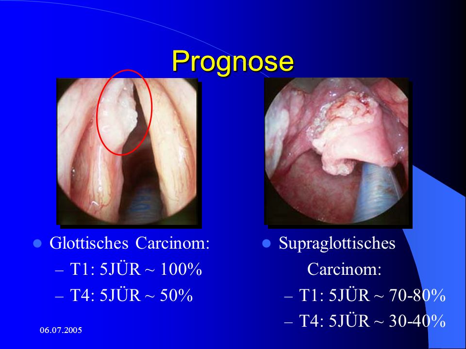 Prognose Prognose Glottisches Carcinom: T1: 5JÜR ~ 100% T4: 5JÜR ~ 50%