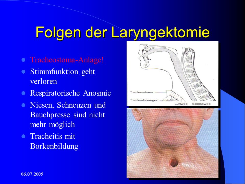 Folgen der Laryngektomie