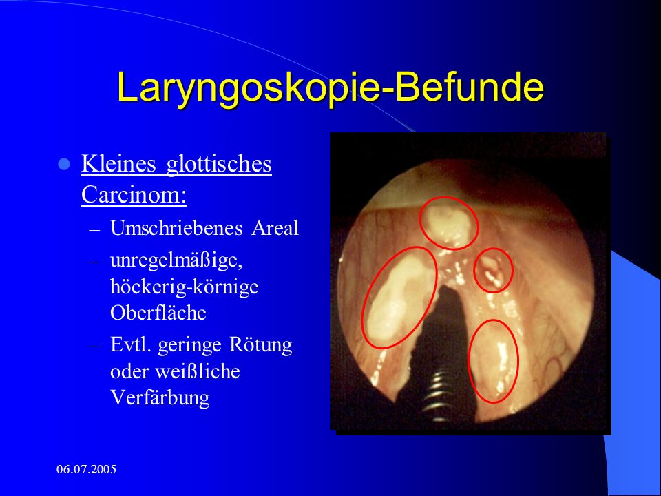 Laryngoskopie-Befunde