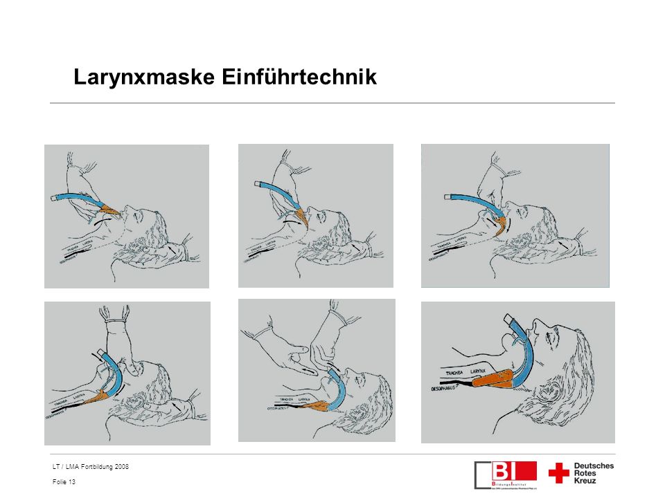 Larynxmaske Einführtechnik