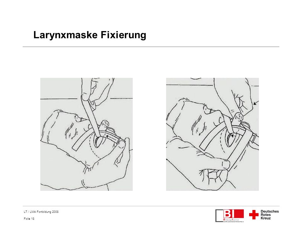 Larynxmaske Fixierung