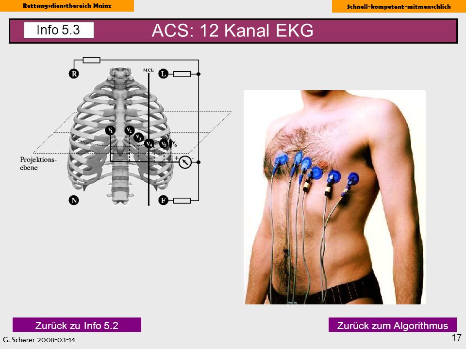 ACS: 12 Kanal EKG Info 5.3 Zurück zu Info 5.2 Zurück zum Algorithmus