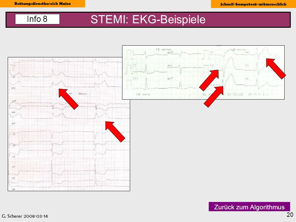STEMI: EKG-Beispiele Info 8 Zurück zum Algorithmus