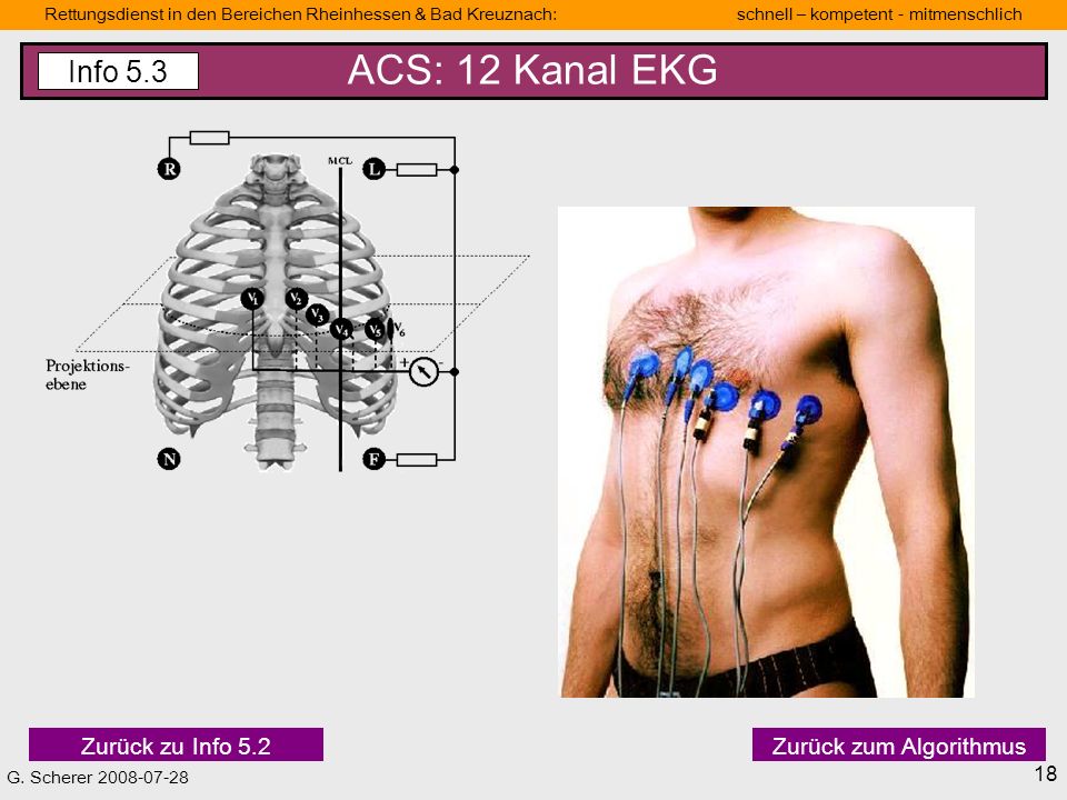 ACS: 12 Kanal EKG Info 5.3 Zurück zu Info 5.2 Zurück zum Algorithmus