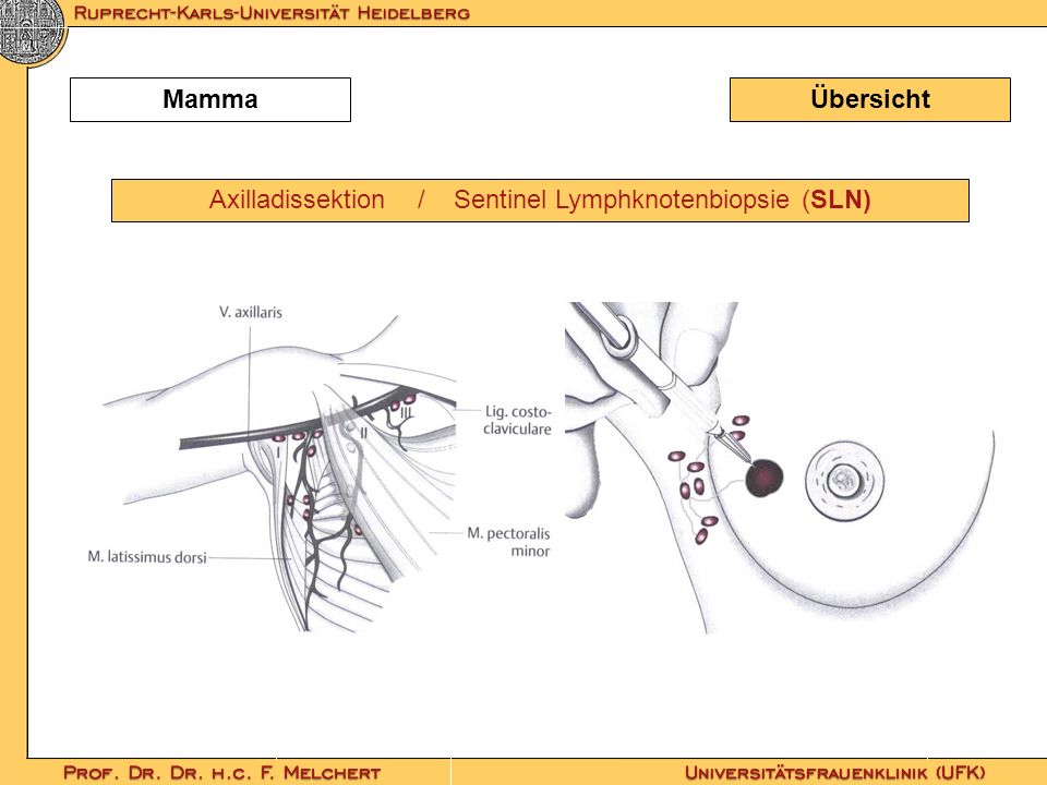 Axilladissektion / Sentinel Lymphknotenbiopsie (SLN)