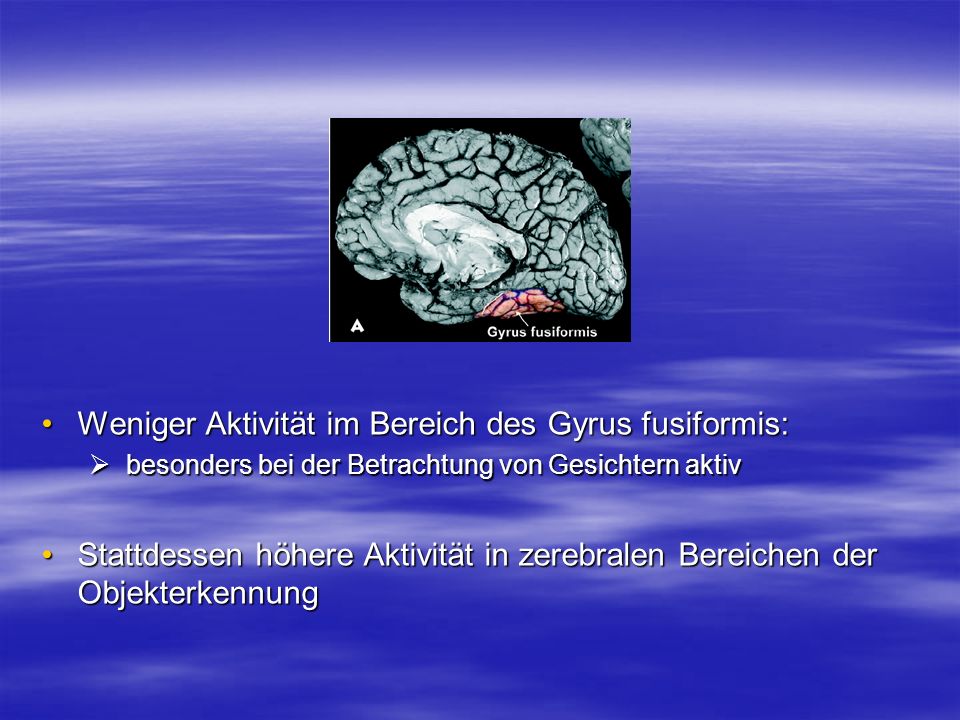 Weniger Aktivität im Bereich des Gyrus fusiformis: