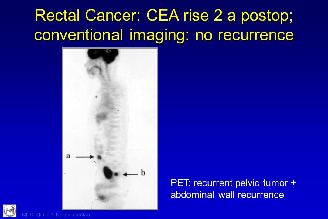 Rectal Cancer: CEA rise 2 a postop; conventional imaging: no recurrence