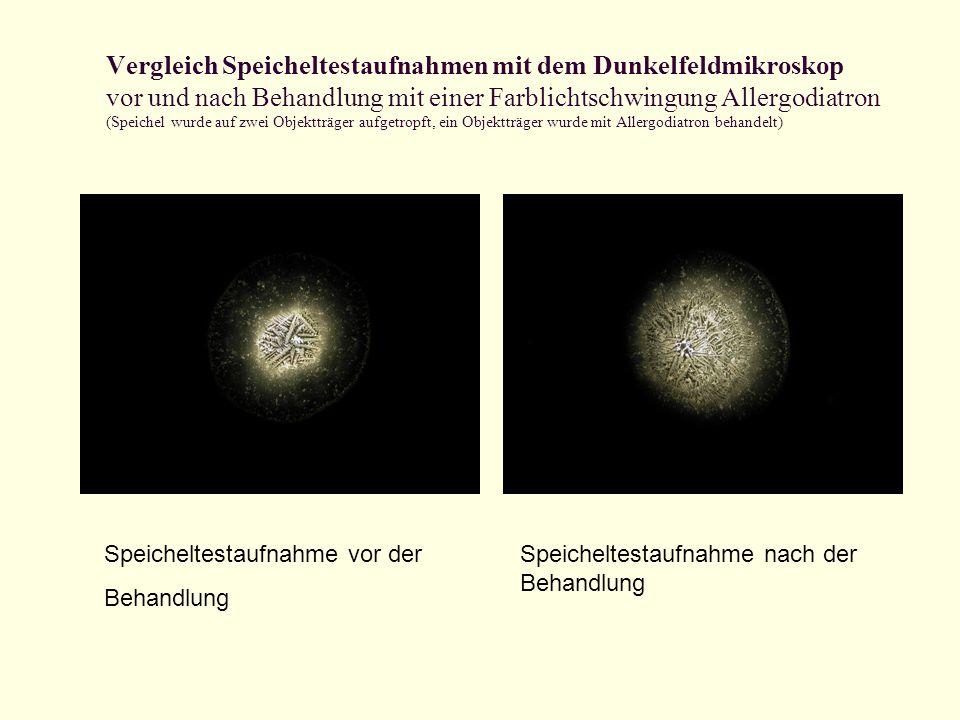 Vergleich Speicheltestaufnahmen mit dem Dunkelfeldmikroskop vor und nach Behandlung mit einer Farblichtschwingung Allergodiatron (Speichel wurde auf zwei Objektträger aufgetropft, ein Objektträger wurde mit Allergodiatron behandelt)